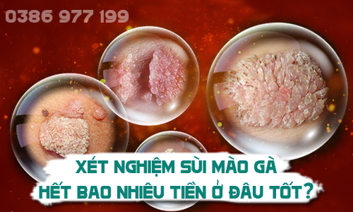 Xét nghiệm sùi mào gà hết bao nhiêu tiền ở đâu tốt?