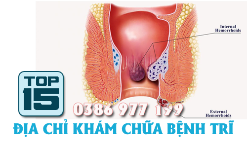 Top 15 địa chỉ khám chữa bệnh trĩ tốt uy tín nhất tại Hà Nội