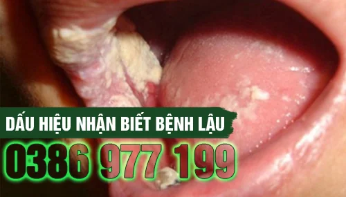 Những dấu hiệu nhận biết bạn đang mắc bệnh lậu